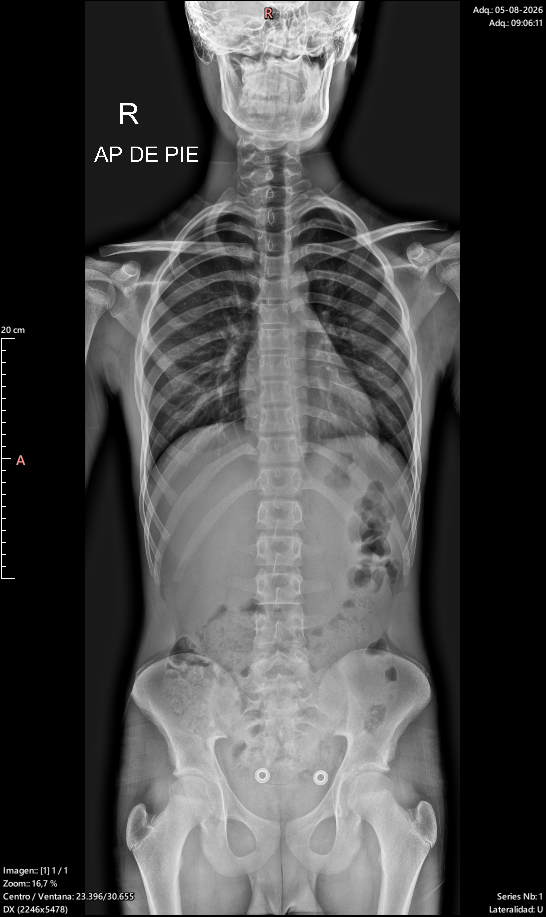 Radiografía de columna completa en una sola imagen